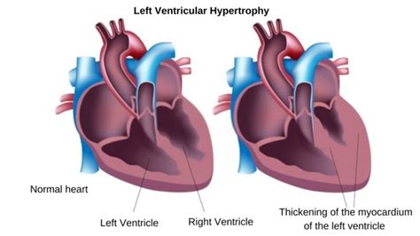 causes of lv hypertrophy|nice cks left ventricular hypertrophy.